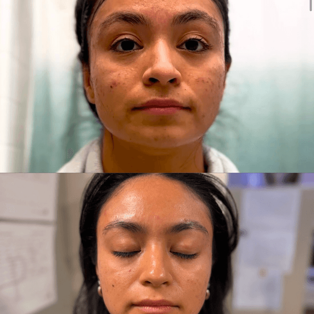 6-week Treatment (Level 1 & 2 Acne)